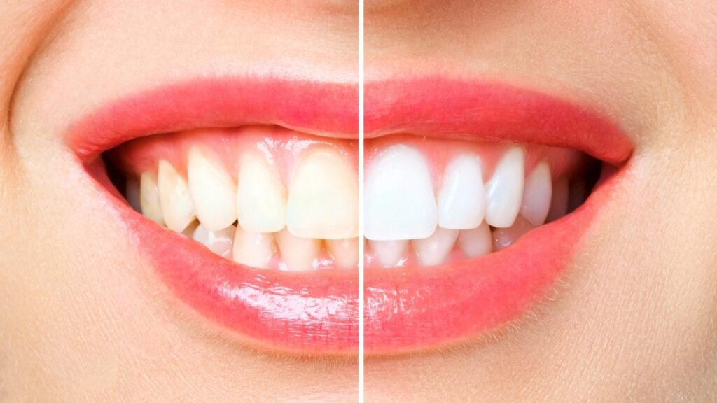 Understanding tooth colour and bleaching